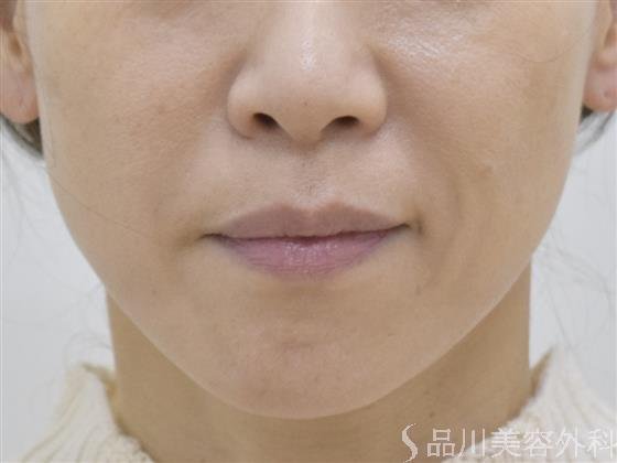 症例NO.51124のAFTER写真