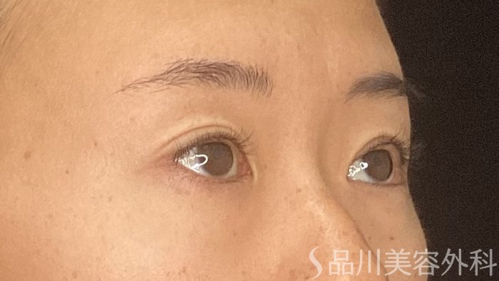 症例NO.74561のBEFORE写真