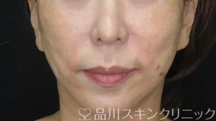 症例NO.72064のAFTER写真