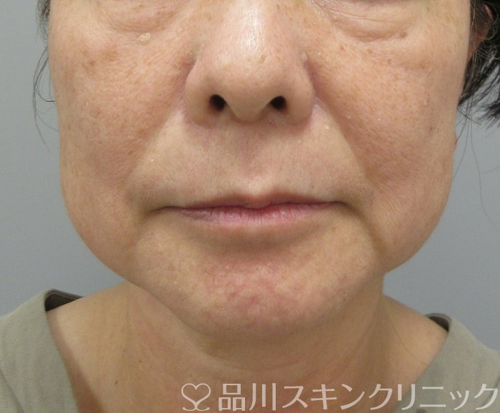 症例NO.74346のBEFORE写真