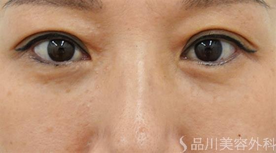 症例NO.46605のAFTER写真