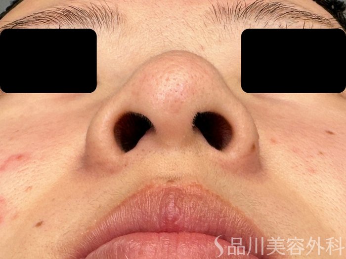 症例NO.74868のBEFORE写真