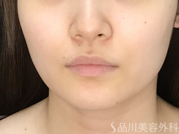 症例NO.71706のBEFORE写真