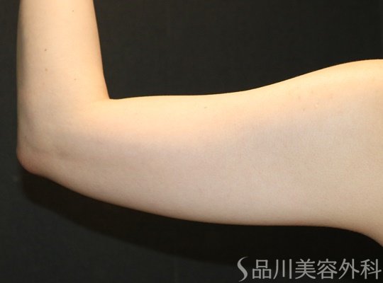 症例NO.74895のBEFORE写真