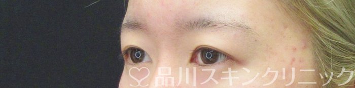 症例NO.63386のBEFORE写真