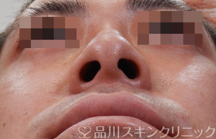症例NO.65975のBEFORE写真