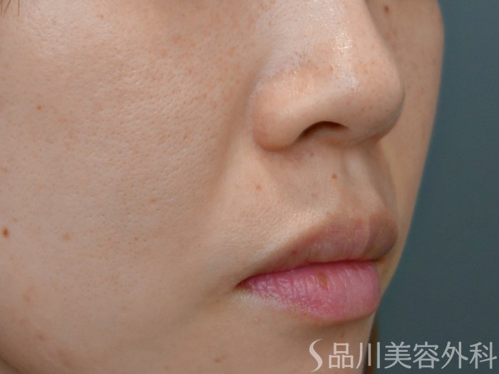 症例NO.71738のBEFORE写真