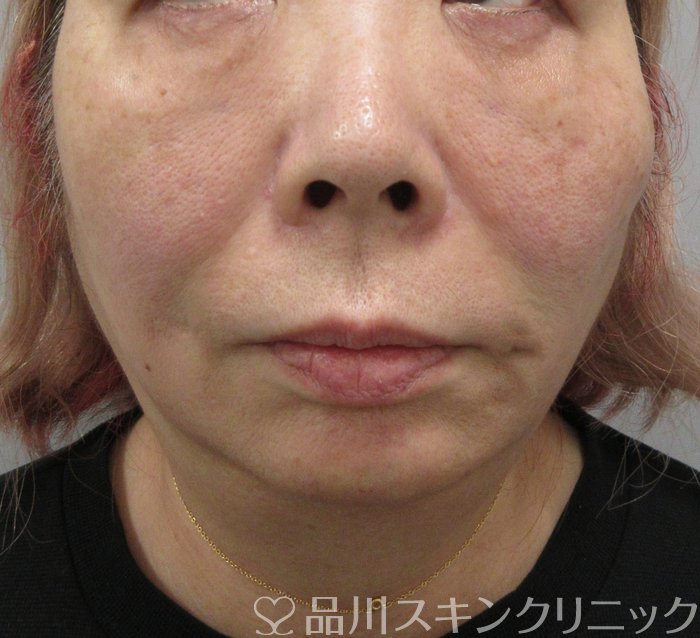 症例NO.73152のAFTER写真