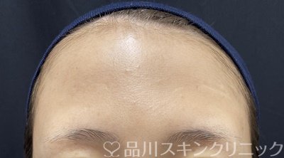 症例NO.63833のBEFORE写真