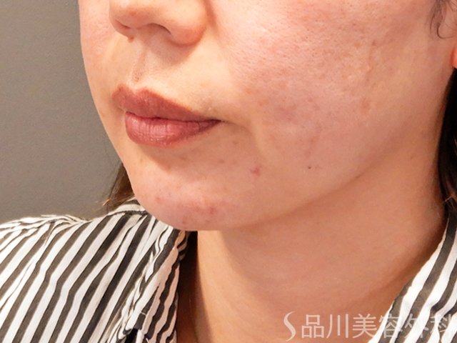 症例NO.69577のAFTER写真