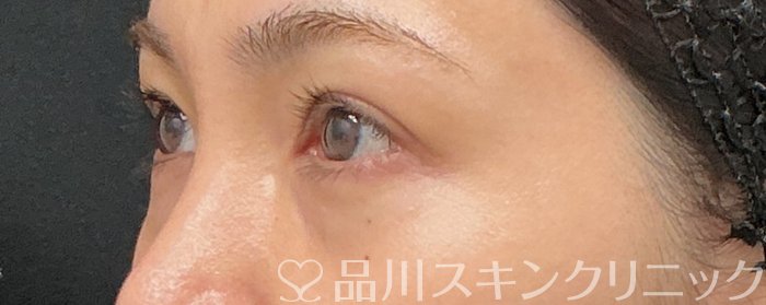症例NO.75164のBEFORE写真