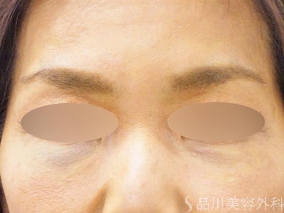症例NO.51420のAFTER写真