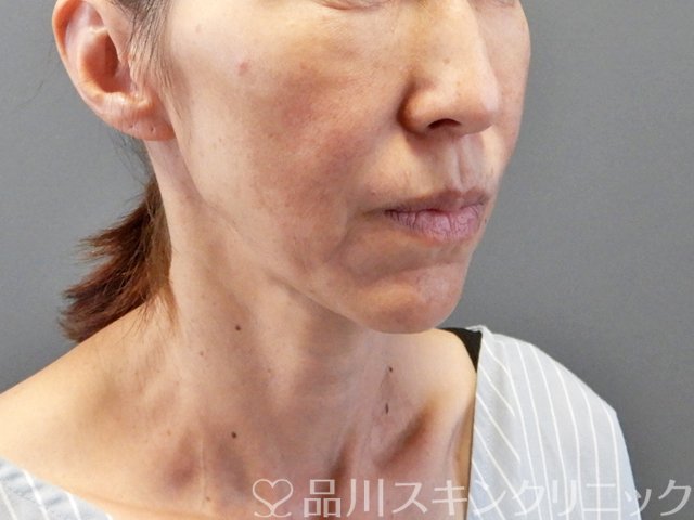 症例NO.66253のBEFORE写真