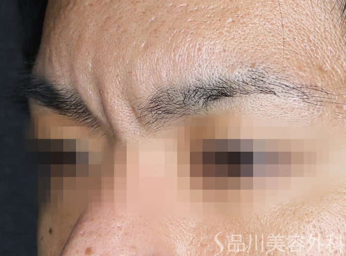 症例NO.73693のBEFORE写真