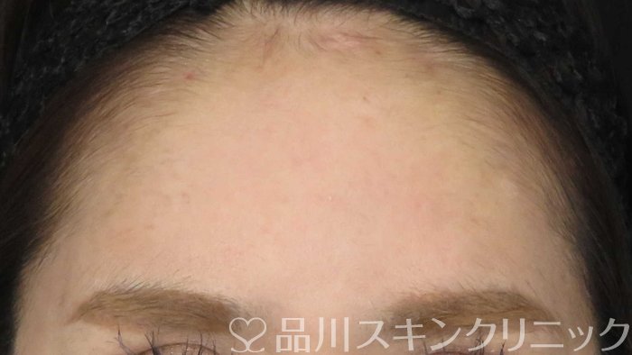 症例NO.71804のAFTER写真