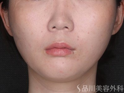 症例NO.74443のAFTER写真