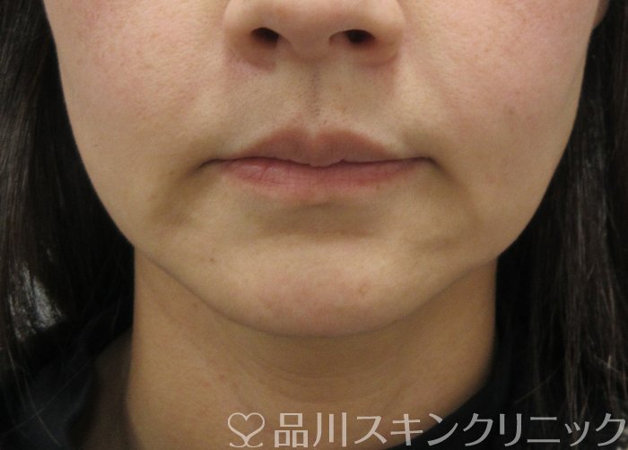 症例NO.75193のBEFORE写真
