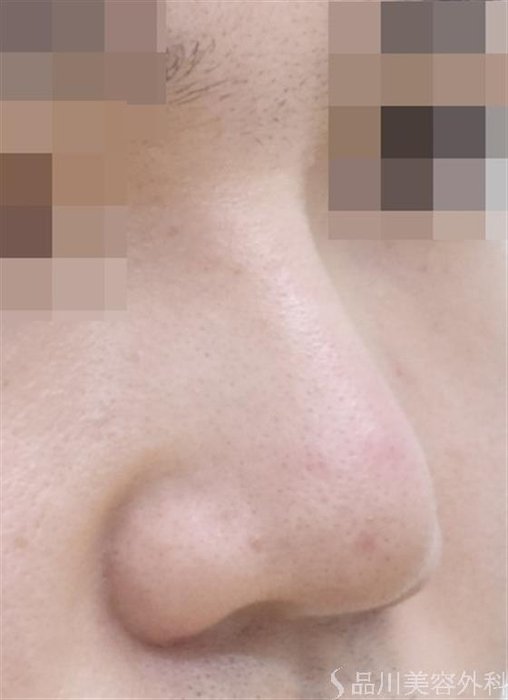 症例NO.47696のAFTER写真
