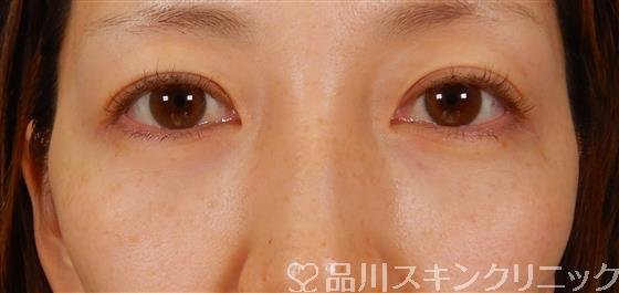 症例NO.61174のAFTER写真