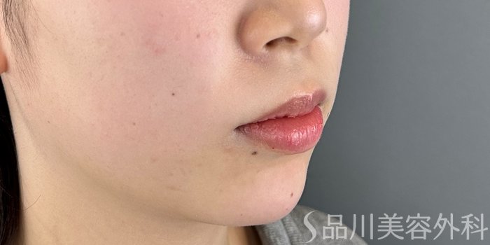 症例NO.72719のAFTER写真