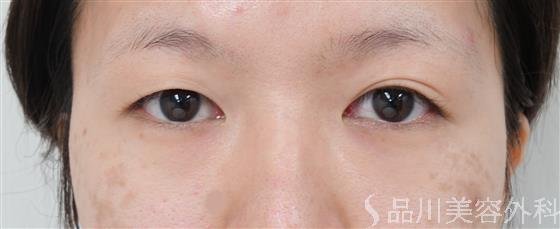 症例NO.39979のBEFORE写真