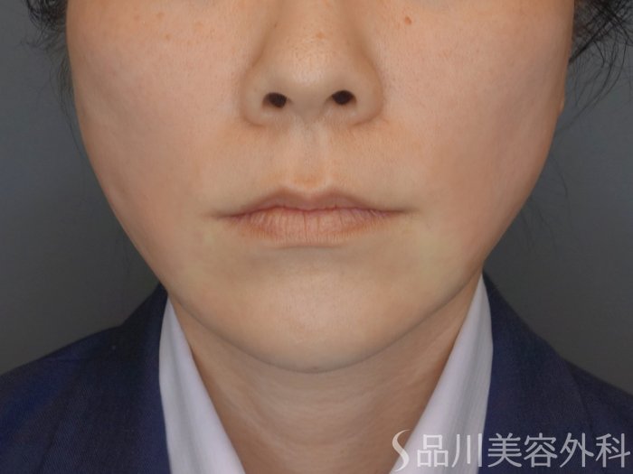 症例NO.70349のAFTER写真