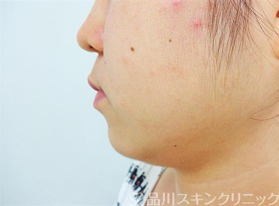 症例NO.26137のBEFORE写真