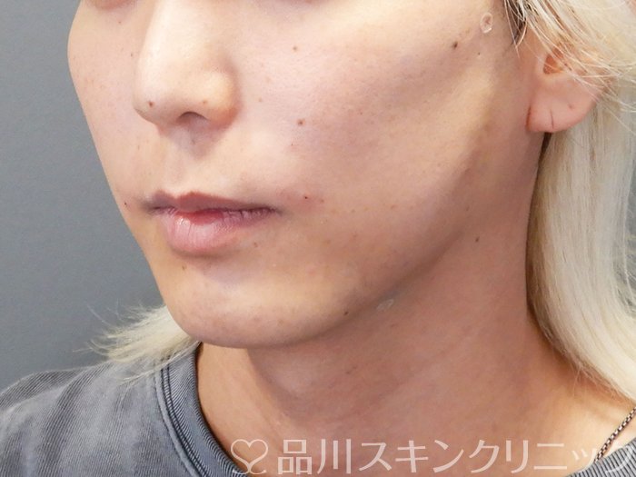 症例NO.74370のAFTER写真