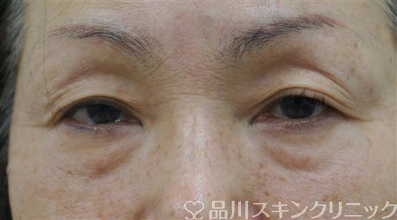 症例NO.39895のBEFORE写真
