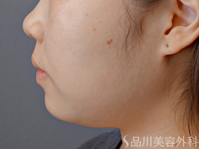 症例NO.73387のBEFORE写真