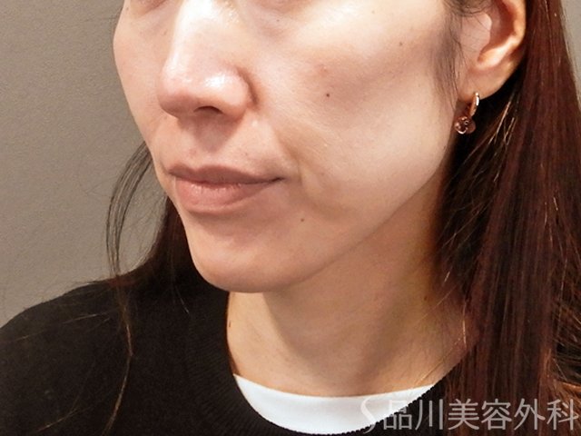 症例NO.67996のBEFORE写真