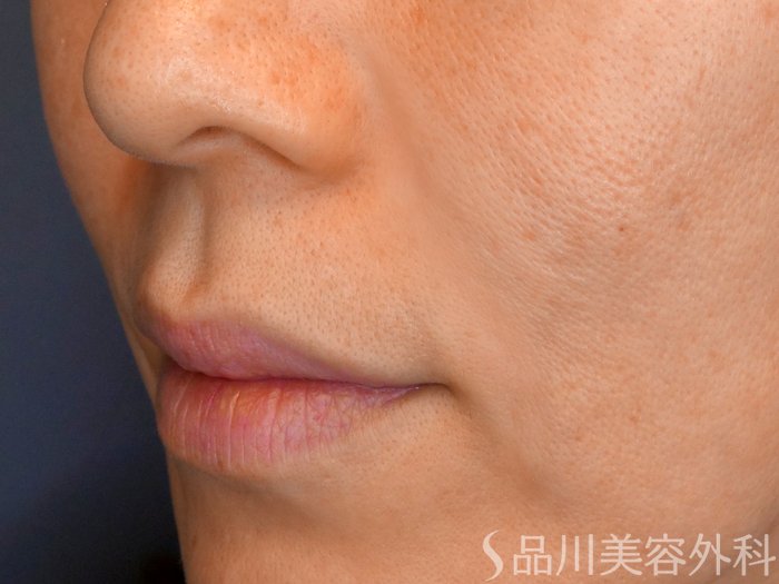 症例NO.67867のAFTER写真