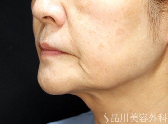症例NO.70228のBEFORE写真