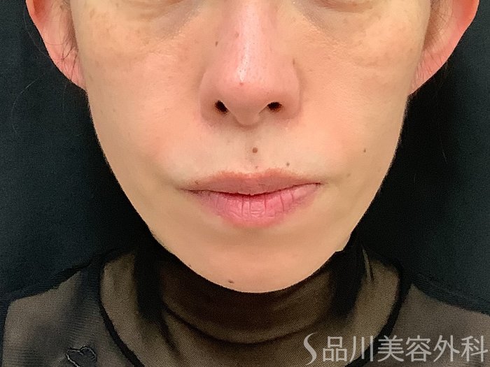 症例NO.67760のAFTER写真