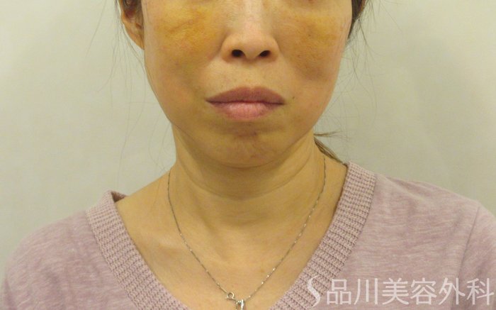 症例NO.72525のAFTER写真