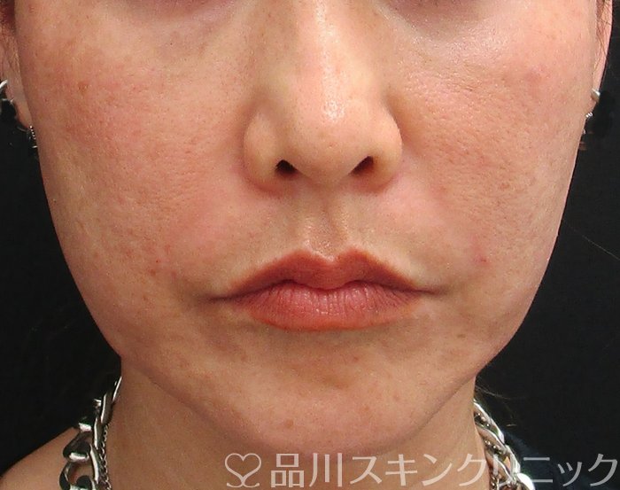 症例NO.75029のAFTER写真
