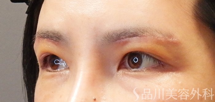 症例NO.67762のAFTER写真