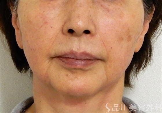 症例NO.39897のAFTER写真
