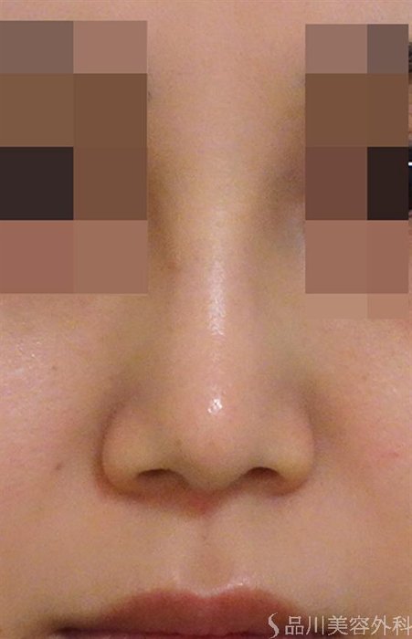 症例NO.44042のAFTER写真
