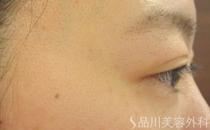 症例NO.71604のAFTER写真