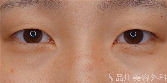 症例NO.59030のBEFORE写真