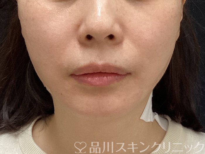 症例NO.69648のAFTER写真