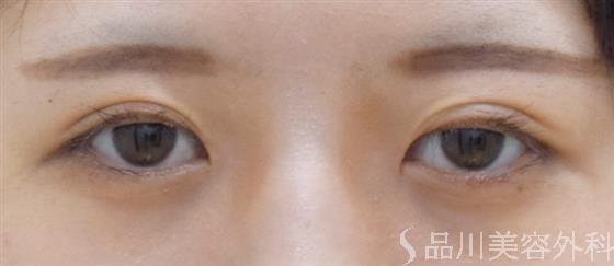 症例NO.58670のAFTER写真