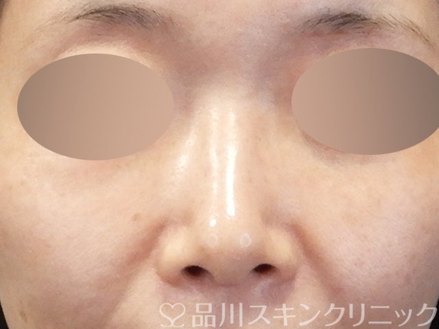 症例NO.67536のBEFORE写真