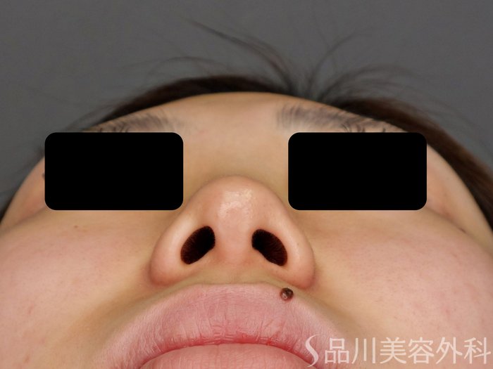 症例NO.73593のBEFORE写真