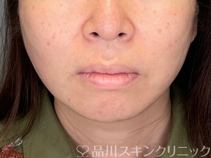症例NO.69460のAFTER写真