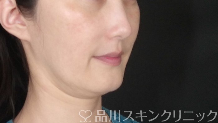 症例NO.72681のBEFORE写真