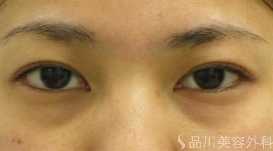 症例NO.47471のBEFORE写真