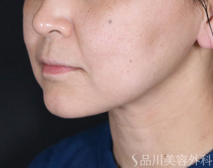 症例NO.73985のBEFORE写真