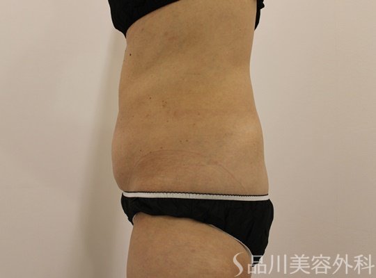 症例NO.73364のAFTER写真